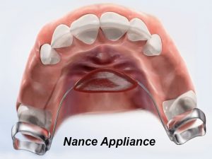 Nance appliance