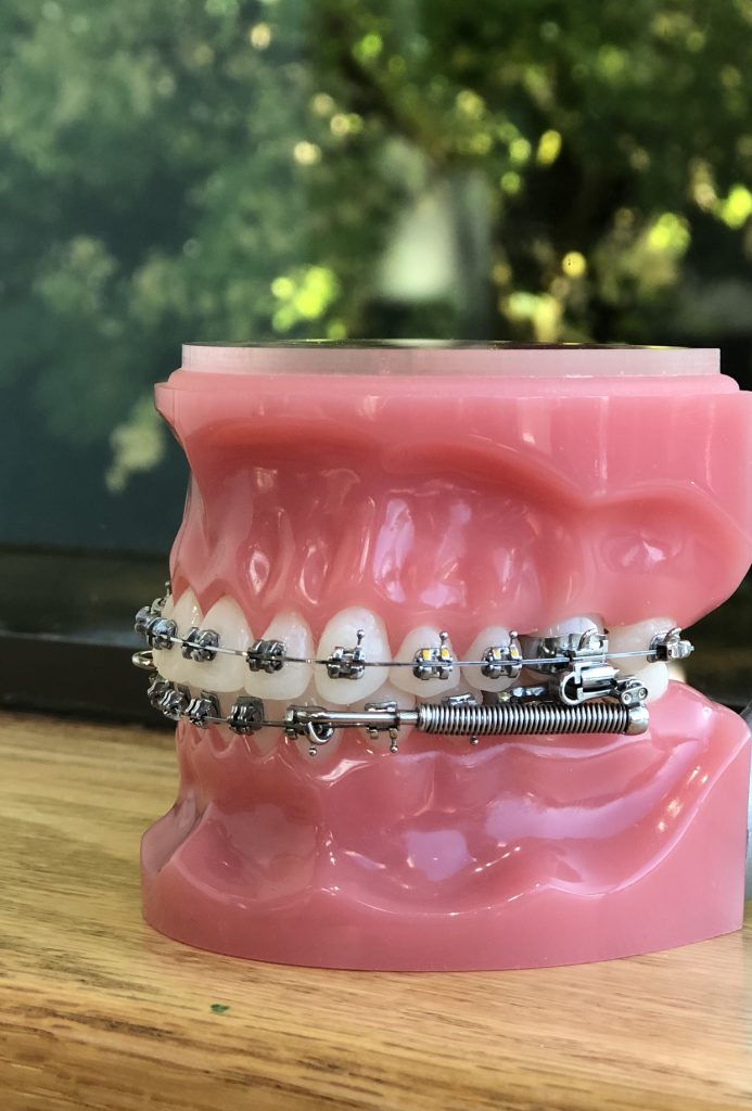 bite correction with dental braces