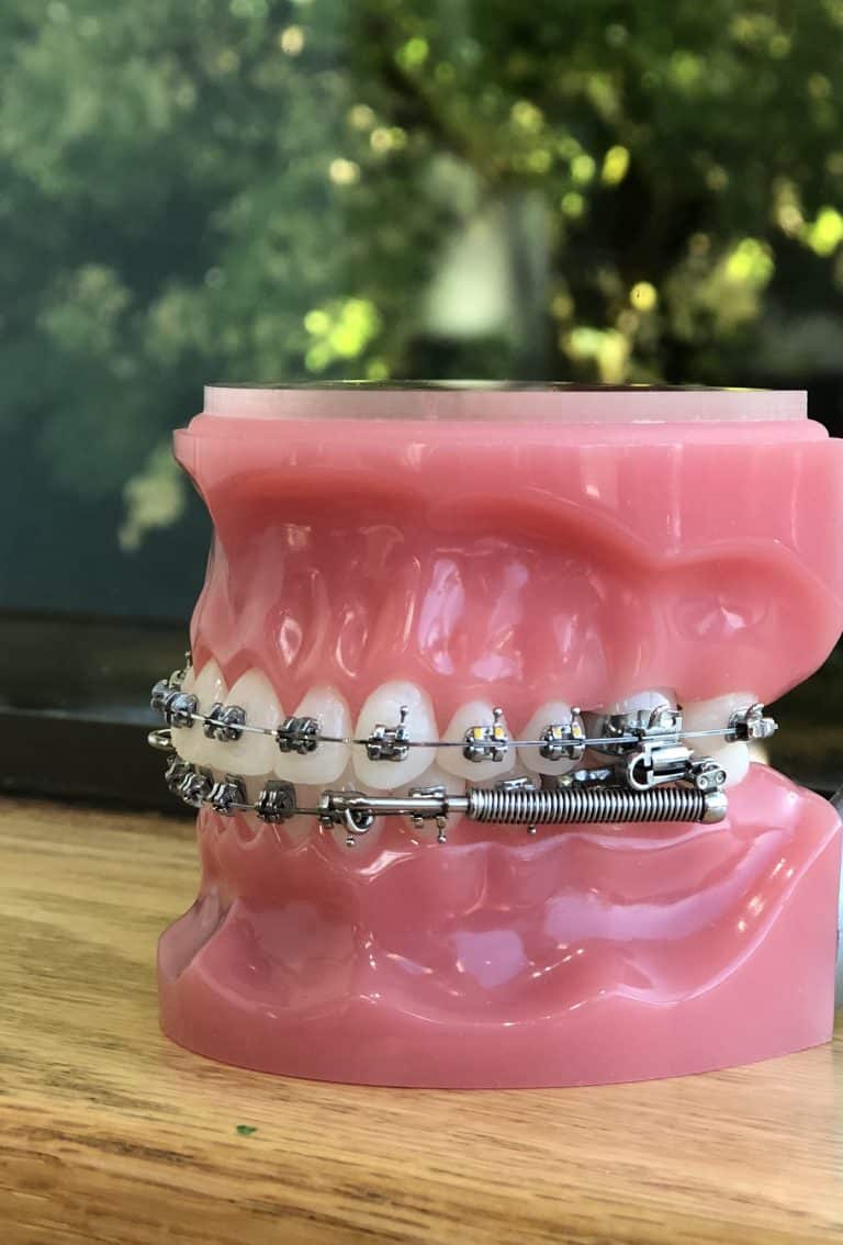Bite Correction Orthodontic Treatment at Portland Braces