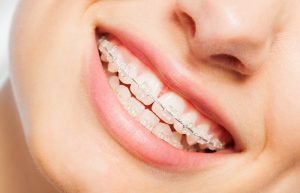 alternatives to metal braces