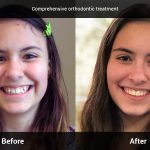 comprehensive orthodontic treatment