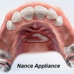 Nance appliance