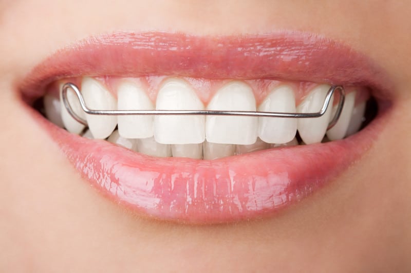 3 Tips On How To Take Care Of Your Retainer Orthodontic Treatment
