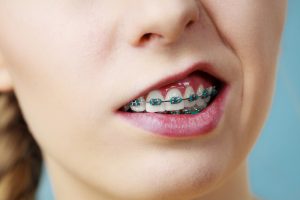 orthodontics for speech problem