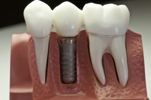 dental implant