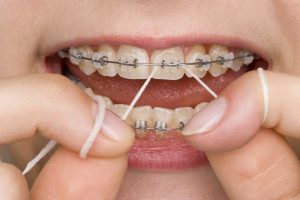 hygiene tips for wearing braces