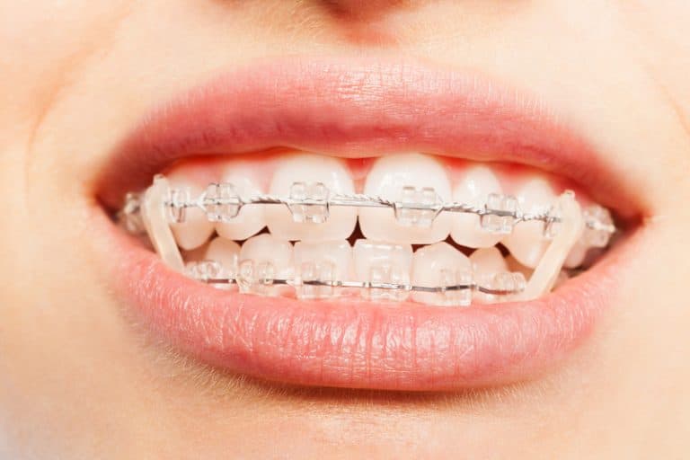 What Are Orthodontic Elastics (Rubber Bands) And How Do They Work