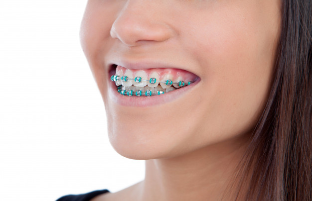 Orthodontics Braces How To Prevent Cavities With Braces