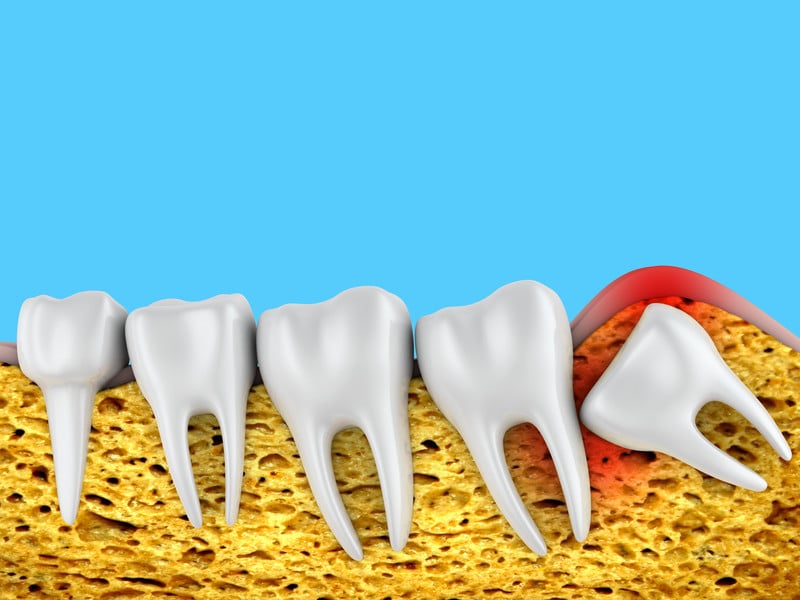 Impacted Wisdom Teeth And Braces What You Should Know