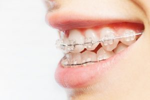 ceramic braces