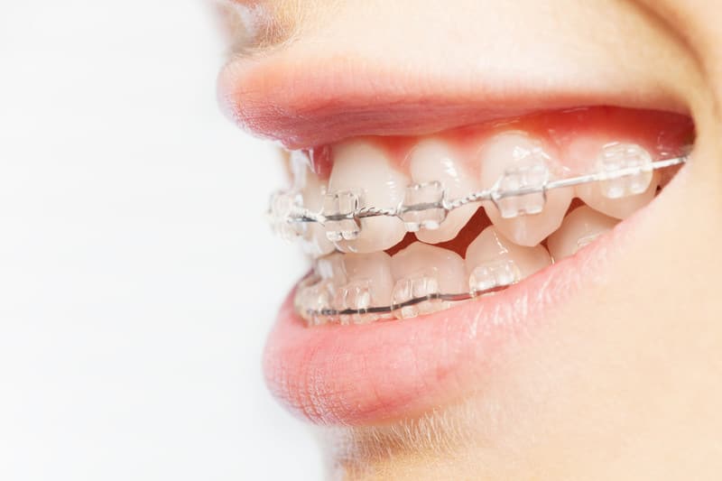 Orthodontics Options 4 Most Common Types of Braces Brackets