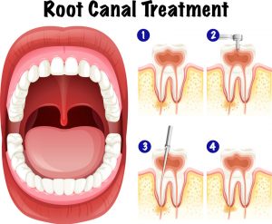 root canal treatment