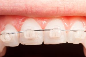 tooth alignment with ceramic braces