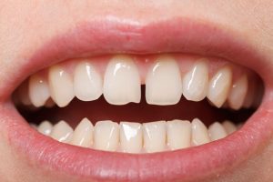 gaps between teeth