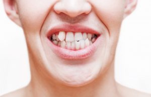 What Causes Crooked Teeth