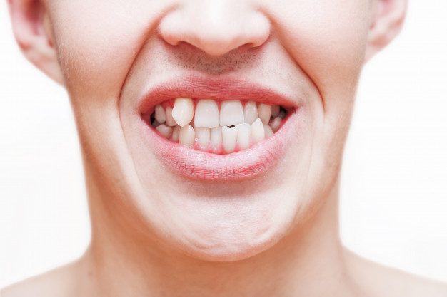 What Causes Crooked Teeth