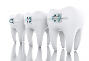 braces after dental implant