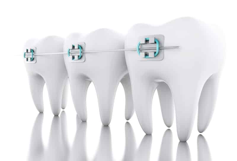 Braces After Dental Implants Orthodontist in Portland, OR