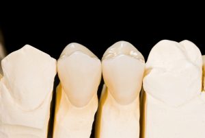 ceramic premolar crowns