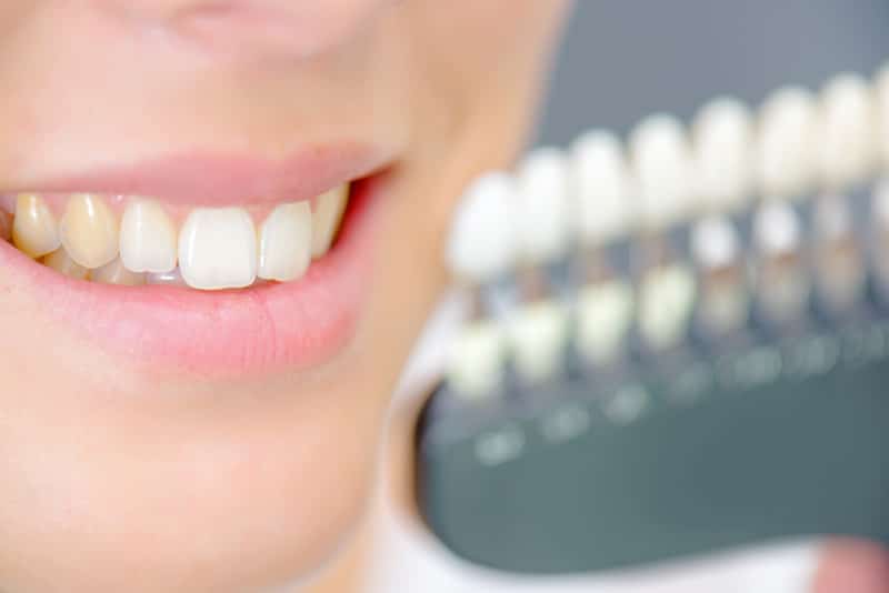 Teeth Stains From Braces Best Ways To Avoid After Treatment