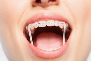 orthodontic elastic bands
