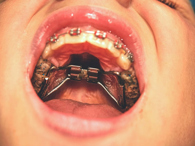 Child’s Orthodontic Expander Portland Braces