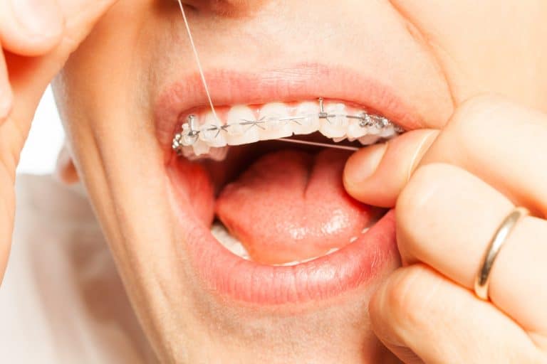 How to Floss with Braces Portland Braces