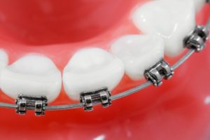 braces brackets