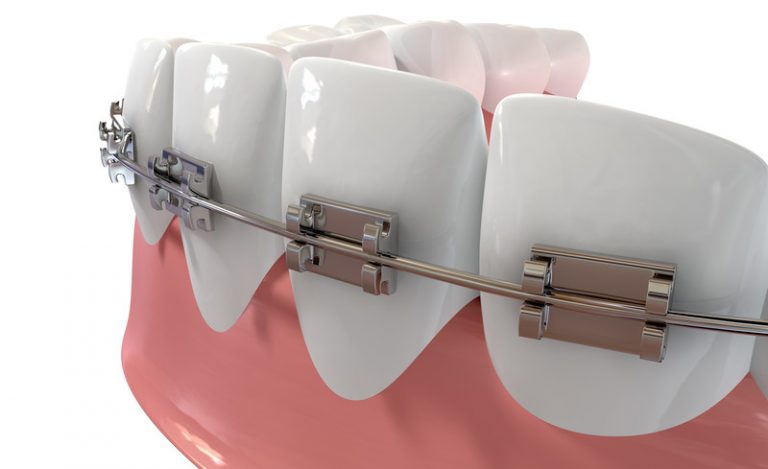 braces wire shifted to one side