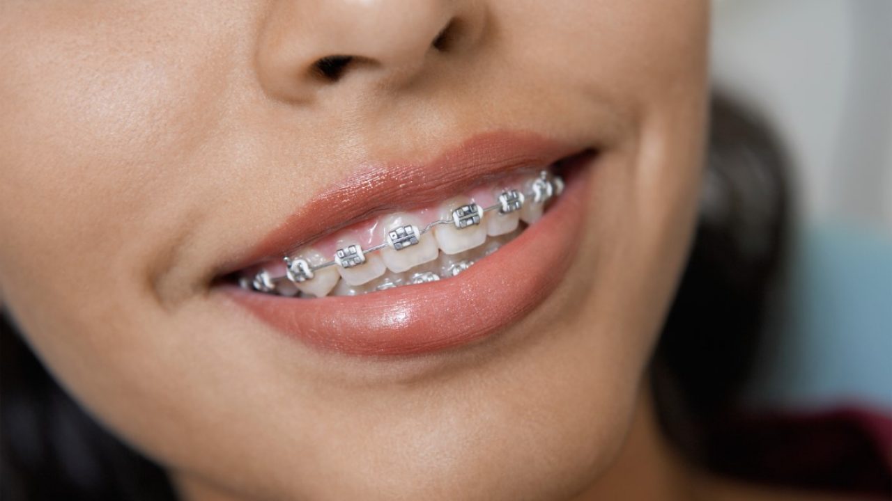 can you put braces on baby teeth Dorie Everett