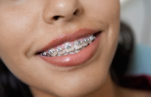 Interceptive Orthodontic treatment